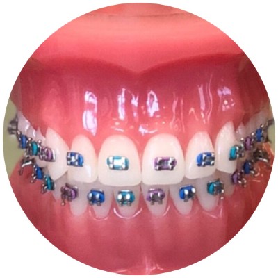 Traditional braces